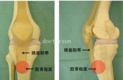 胫骨结节骨骺炎,胫骨结节骨骺炎的成因、症状与防治